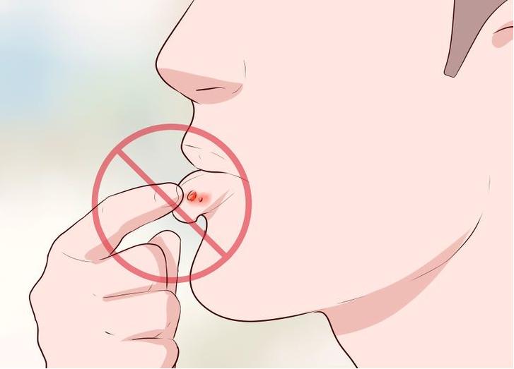 how to deal herpes outbreak 