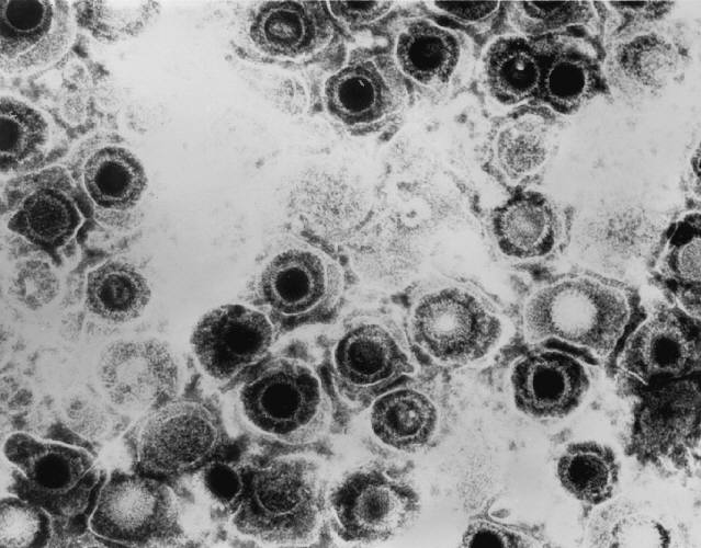 herpes simples virus 